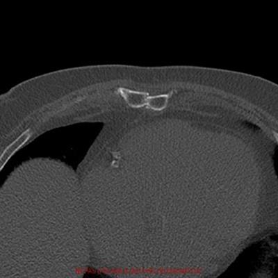 Percutaneous Cementoplasty to Treat Sternal Instability After Cardiac Surgery